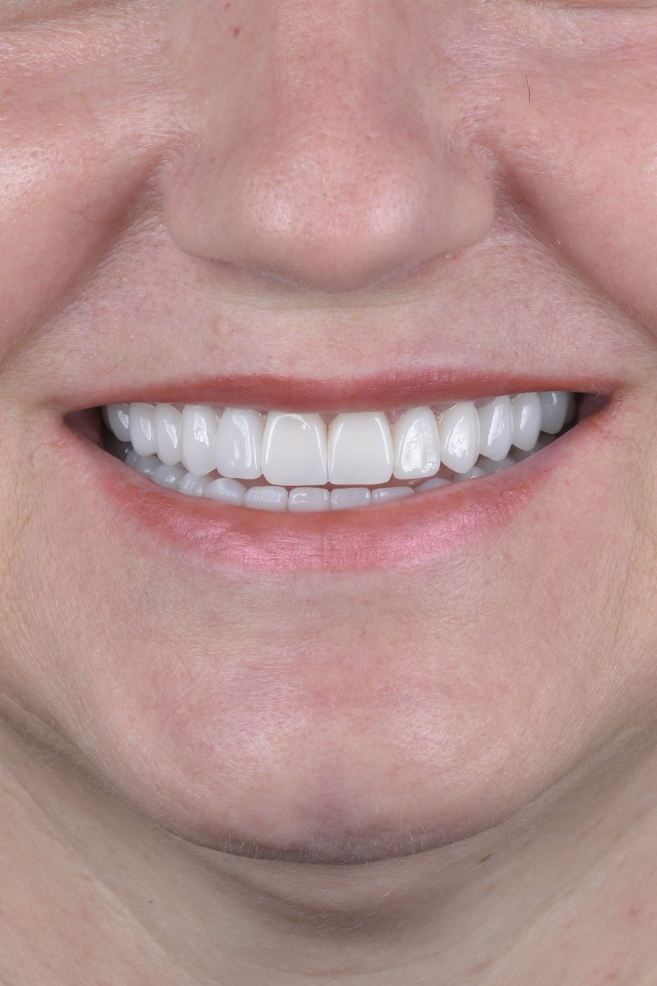 Authentic clinical smile transformation by Dr. T-Smile