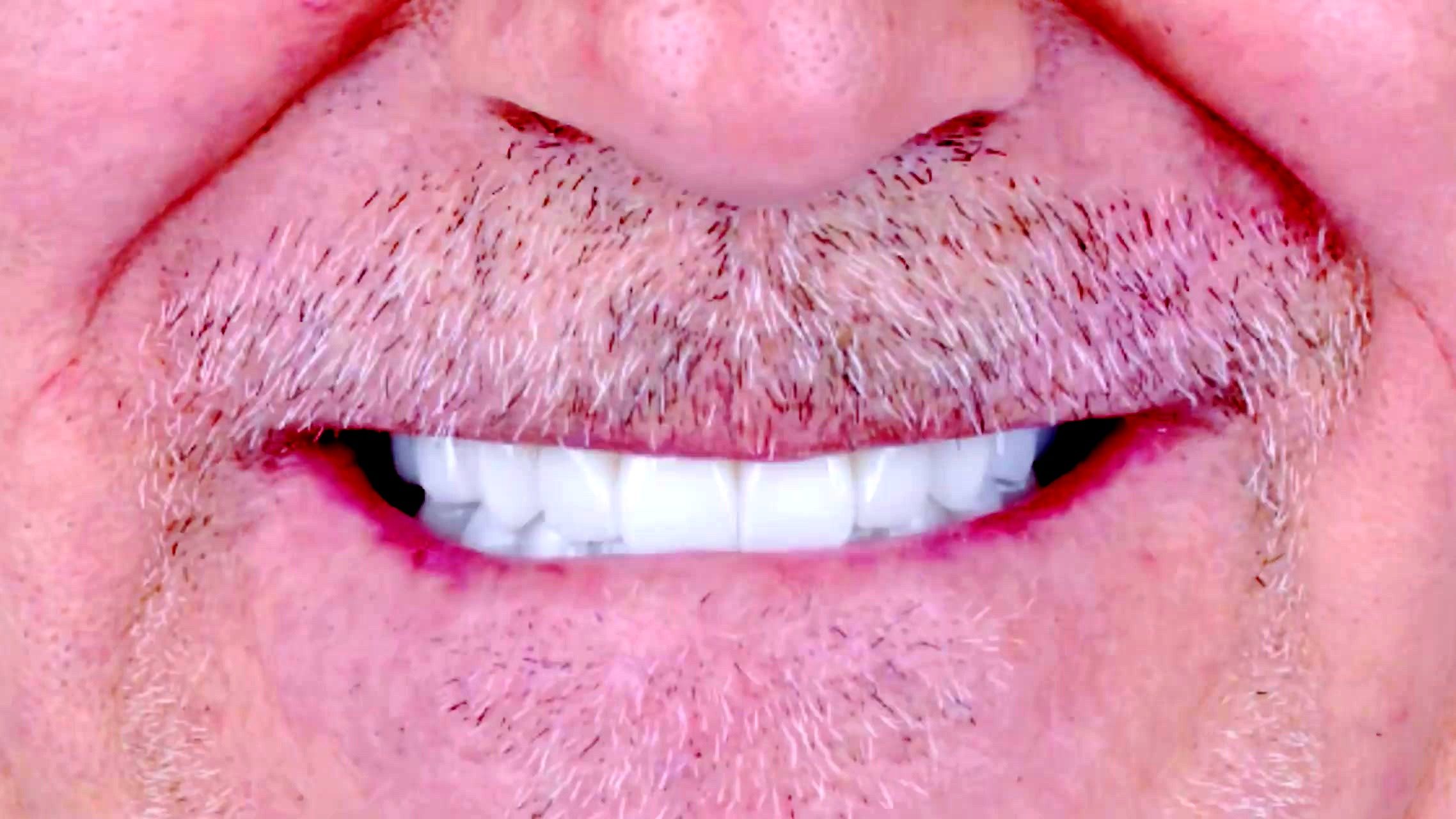 Layered Zirconia Smile Reveal & Balanced Lip Dynamics